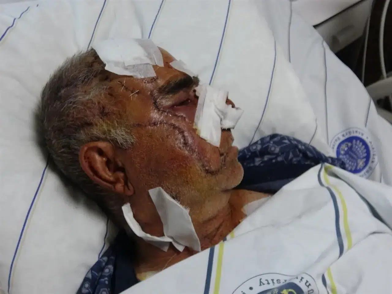 AĞRI'DA AYI SALDIRISINDA YÜZÜ PARAMPARÇA OLDU!