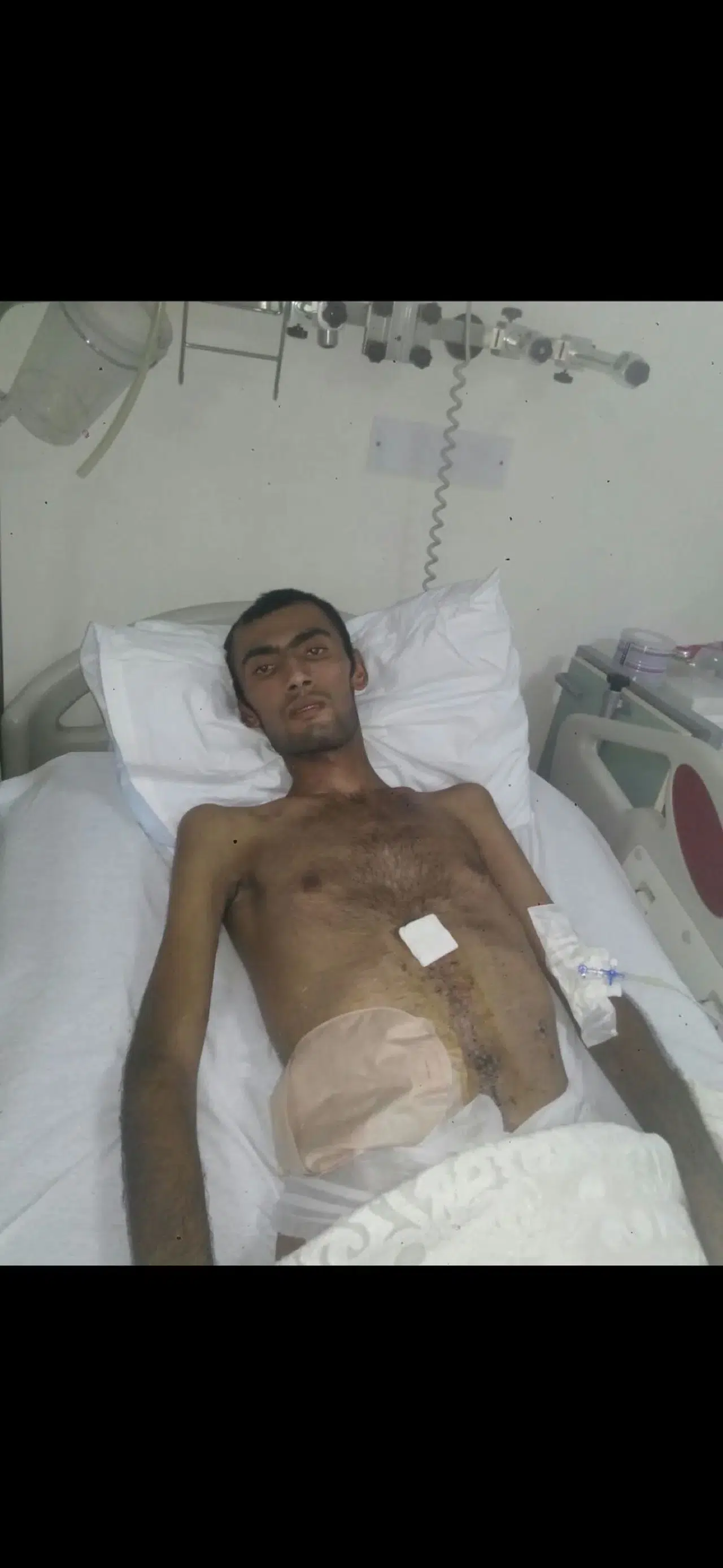 GAZİ ADNAN ER 54.AMELİYATINI OLARAK HAYATA TUTUNMAYA ÇALIŞIYOR!