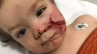 ANKARA'DA PİTBULL SALDIRDI! İKİ KARDEŞ SON ANDA YARALI KURTULDU!