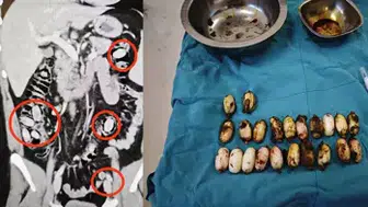 25 YAŞINDAKİ GENCİN MİDESİNDEN 25 ADET BONZAİ ÇIKTI!