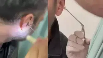 POLİS UYUŞTURUCUYU KULAĞINA GİZLEYEN ŞÜPHELİYİ YAKALADI!