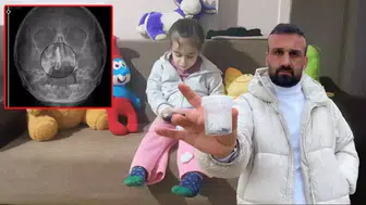 5 YAŞINDAKİ POLEN 2 YILDIR BURNUNDAKİ ZİNCİRLE YAŞAMIŞ!