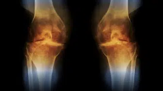 FLAŞ HABER! GELİŞTİRİLEN YENİ AŞI İLE DİZ KAPAĞI KIKIRDAĞI YENİDEN OLUŞUYOR!