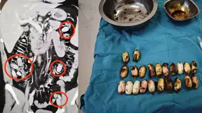 25 YAŞINDAKİ GENCİN MİDESİNDEN 25 ADET BONZAİ ÇIKTI!