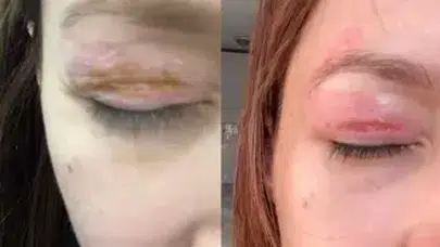 GÖZ KAPAĞI HASAR GÖRDÜ! ŞİKAYETİ DİKKATE ALINMADI!