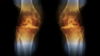 GELİŞTİRİLEN YENİ AŞI İLE DİZ KAPAĞI KIKIRDAĞI YENİDEN OLUŞUYOR!