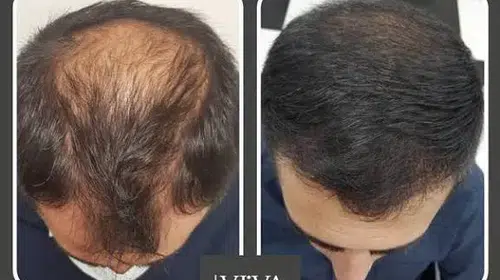 YAKLAŞIK 2 MİLYAR ERKEK BU ÜRÜNÜN SONUÇLARINI BEKLİYOR!