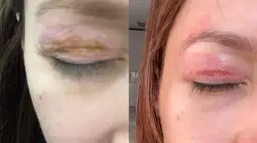 GÖZ KAPAĞI HASAR GÖRDÜ! ŞİKAYETİ DİKKATE ALINMADI!