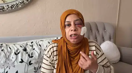 ELEKTRİKLİ BİSİKLET İLE KIRIK RÖGORA DÜŞTÜ! 14 DİKİŞ ATILDI!