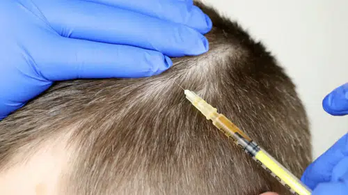 FLAŞ HABER! JAPON BİLİM İNSANLARI SAÇI YENİDEN ÜRETMEYİ BAŞARDI!