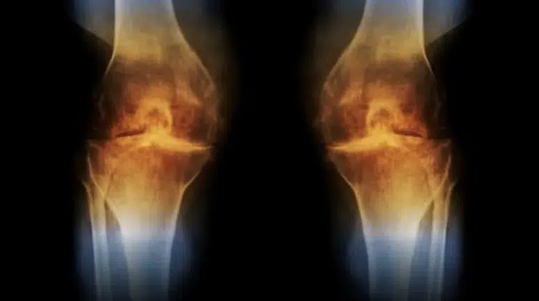 GELİŞTİRİLEN YENİ AŞI İLE DİZ KAPAĞI KIKIRDAĞI YENİDEN OLUŞUYOR!