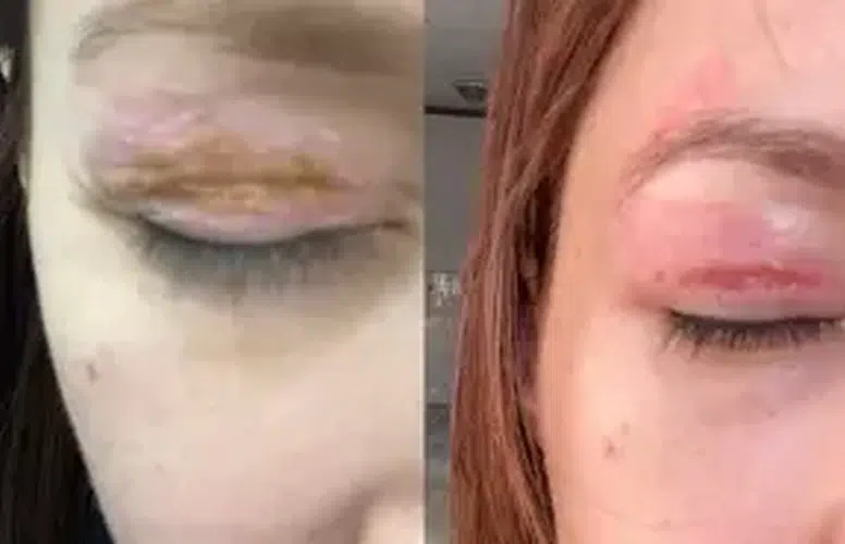 GÖZ KAPAĞI HASAR GÖRDÜ! ŞİKAYETİ DİKKATE ALINMADI!