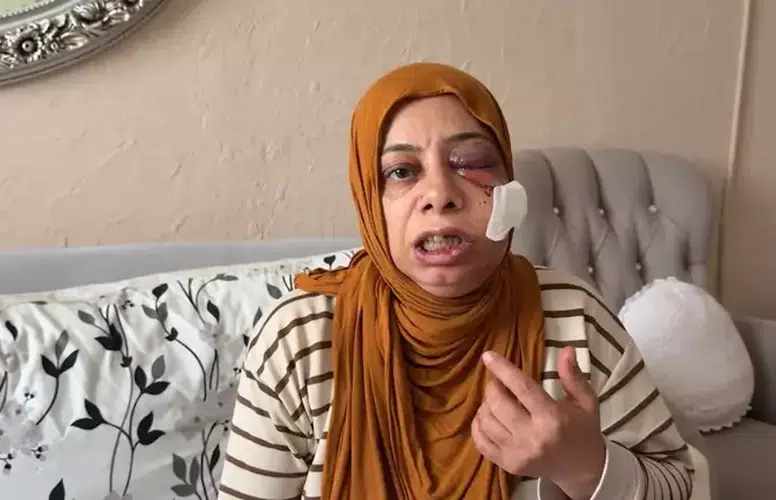 ELEKTRİKLİ BİSİKLET İLE KIRIK RÖGORA DÜŞTÜ! 14 DİKİŞ ATILDI!